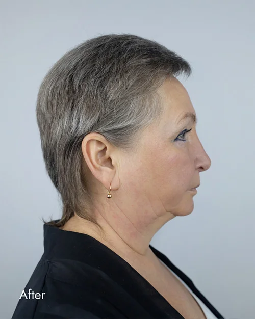 Before and After Photos Chevy Chase, MD Ikon Plastic Surgery and Medical Aesthetics Dr. James Economides