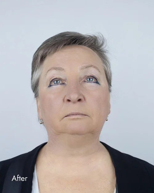Before and After Photos Chevy Chase, MD Ikon Plastic Surgery and Medical Aesthetics Dr. James Economides