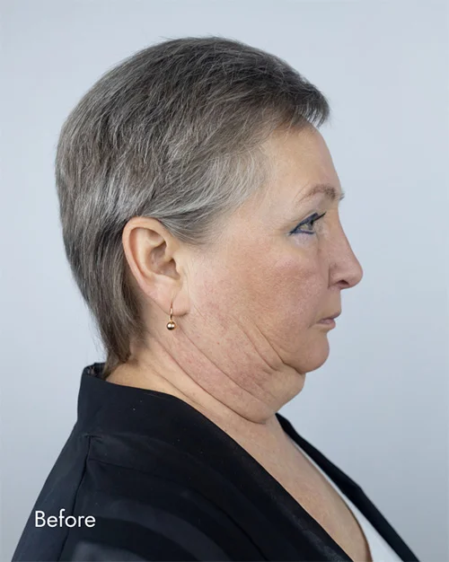 Before and After Photos Chevy Chase, MD Ikon Plastic Surgery and Medical Aesthetics Dr. James Economides