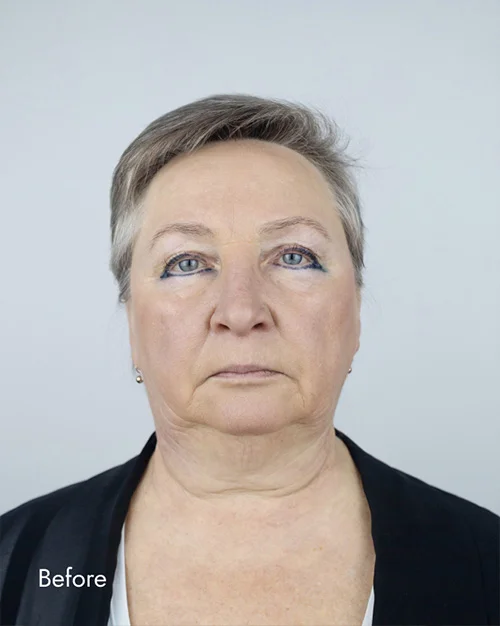Before and After Photos Chevy Chase, MD Ikon Plastic Surgery and Medical Aesthetics Dr. James Economides