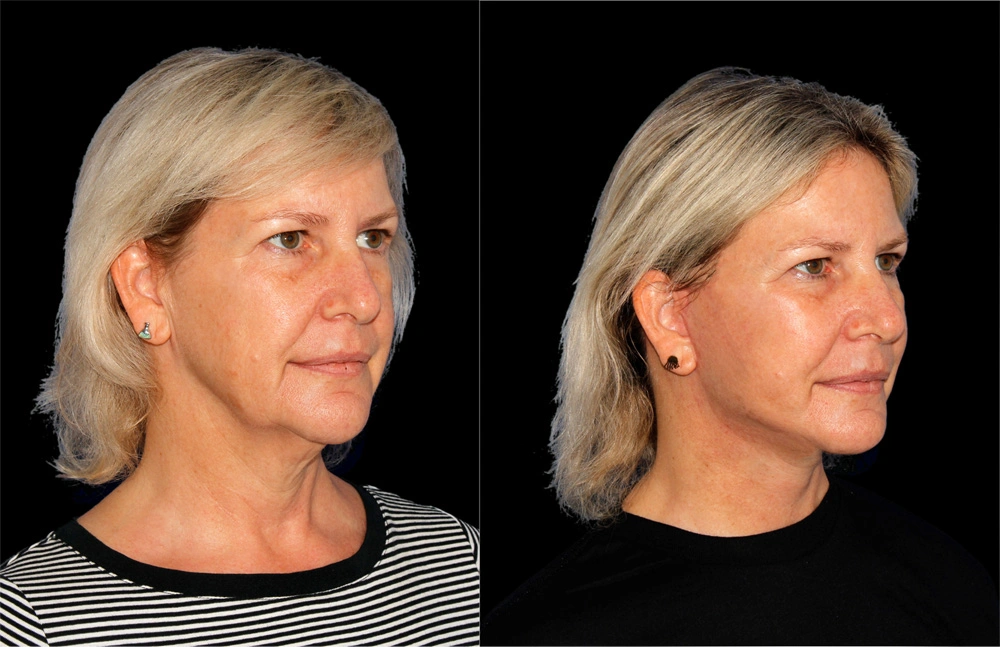Before and After Photos Chevy Chase, MD Ikon Plastic Surgery and Medical Aesthetics Dr. James Economides