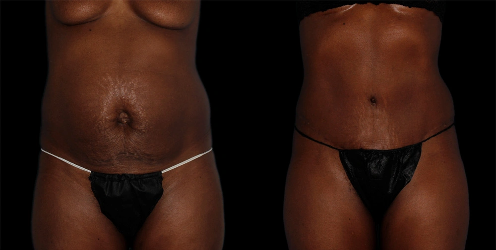 Before and After Photos Chevy Chase, MD Ikon Plastic Surgery and Medical Aesthetics Dr. James Economides