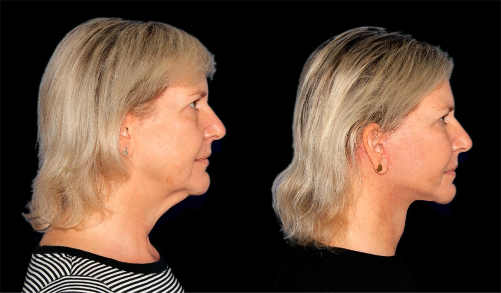 Before and After Photos Chevy Chase, MD Ikon Plastic Surgery and Medical Aesthetics Dr. James Economides