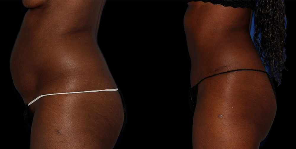 Before and After Photos Chevy Chase, MD Ikon Plastic Surgery and Medical Aesthetics Dr. James Economides