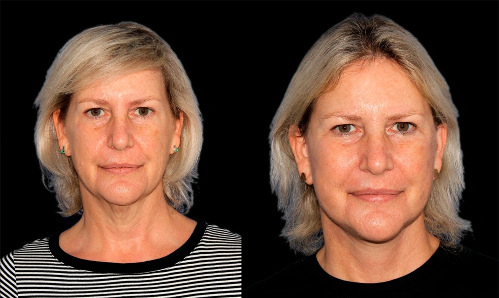 Before and After Photos Chevy Chase, MD Ikon Plastic Surgery and Medical Aesthetics Dr. James Economides