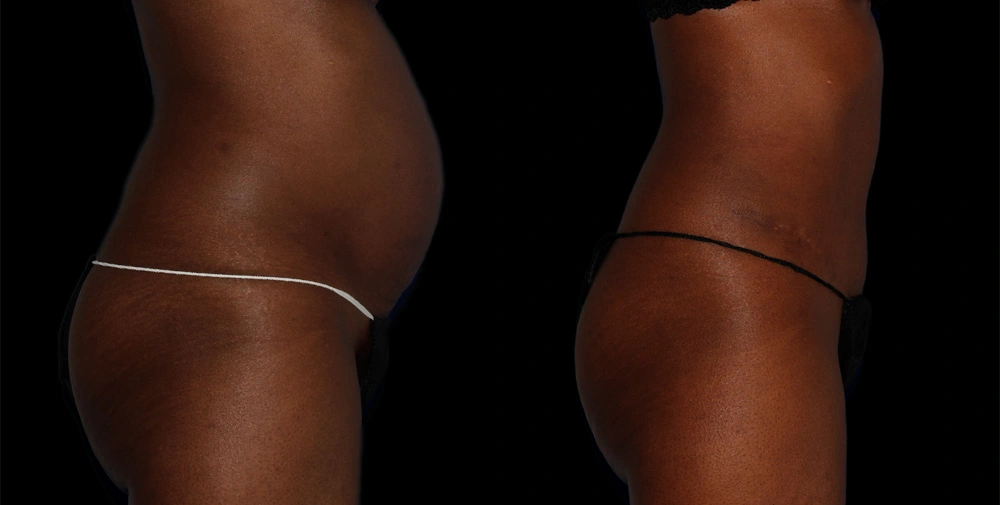 Before and After Photos Chevy Chase, MD Ikon Plastic Surgery and Medical Aesthetics Dr. James Economides