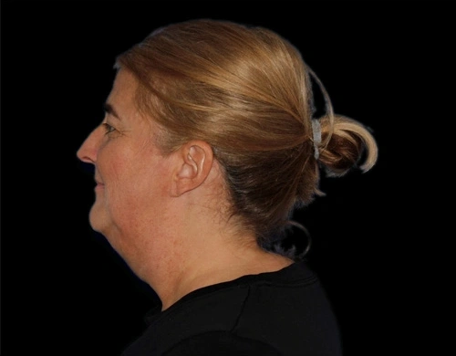 Before and After Photos Chevy Chase, MD Ikon Plastic Surgery and Medical Aesthetics Dr. James Economides