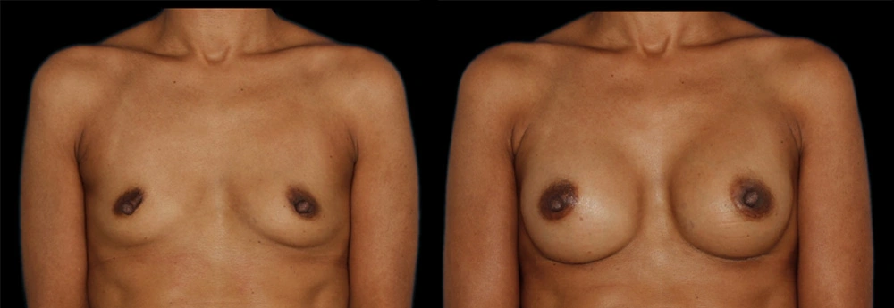 Before and After Photos Chevy Chase, MD Ikon Plastic Surgery and Medical Aesthetics Dr. James Economides