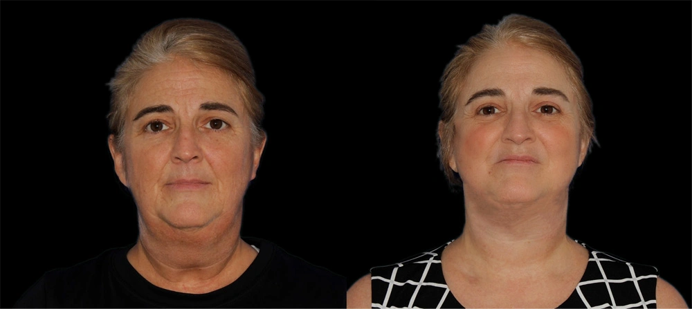 Before and After Photos Chevy Chase, MD Ikon Plastic Surgery and Medical Aesthetics Dr. James Economides