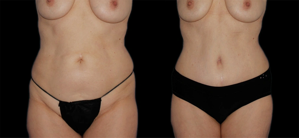 Before and After Photos Chevy Chase, MD Ikon Plastic Surgery and Medical Aesthetics Dr. James Economides