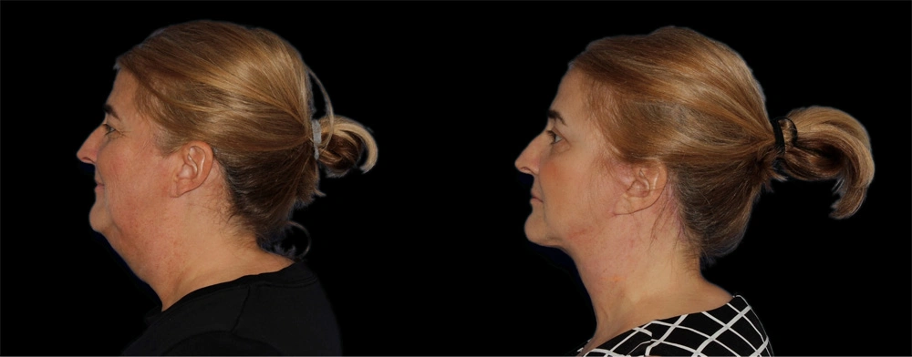 Before and After Photos Chevy Chase, MD Ikon Plastic Surgery and Medical Aesthetics Dr. James Economides