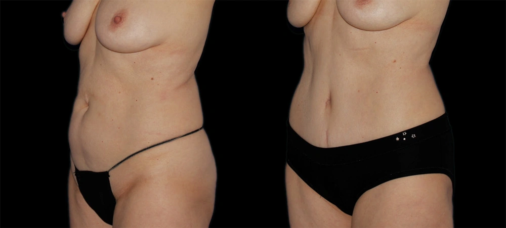Before and After Photos Chevy Chase, MD Ikon Plastic Surgery and Medical Aesthetics Dr. James Economides