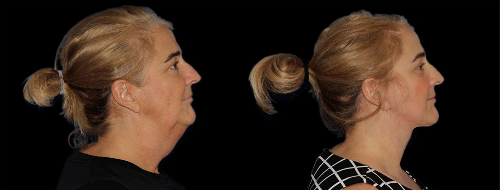 Before and After Photos Chevy Chase, MD Ikon Plastic Surgery and Medical Aesthetics Dr. James Economides