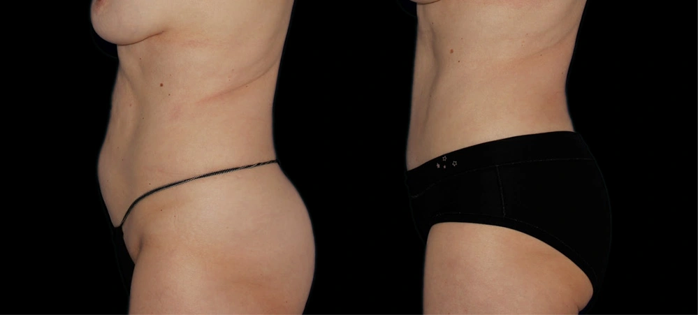 Before and After Photos Chevy Chase, MD Ikon Plastic Surgery and Medical Aesthetics Dr. James Economides