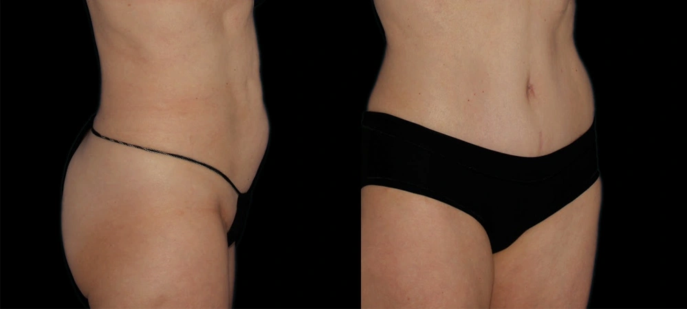Before and After Photos Chevy Chase, MD Ikon Plastic Surgery and Medical Aesthetics Dr. James Economides