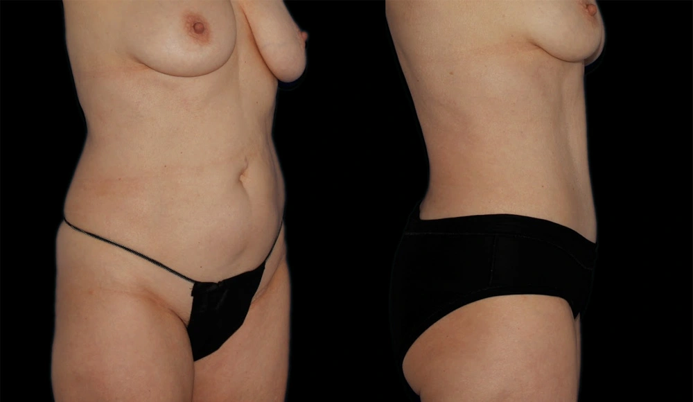 Before and After Photos Chevy Chase, MD Ikon Plastic Surgery and Medical Aesthetics Dr. James Economides