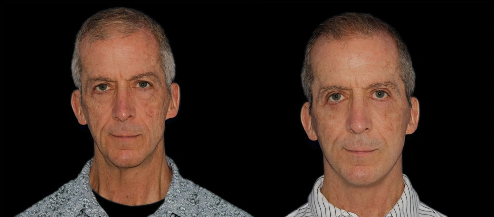 Before and After Photos Chevy Chase, MD Ikon Plastic Surgery and Medical Aesthetics Dr. James Economides