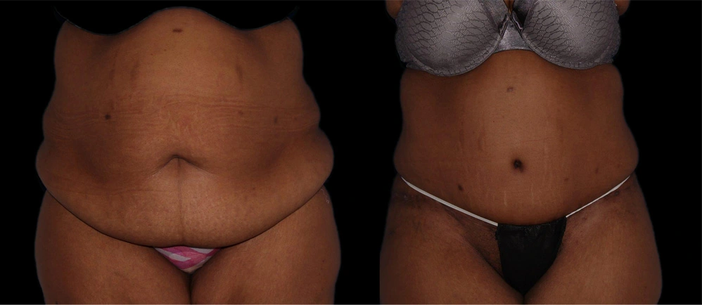 Before and After Photos Chevy Chase, MD Ikon Plastic Surgery and Medical Aesthetics Dr. James Economides