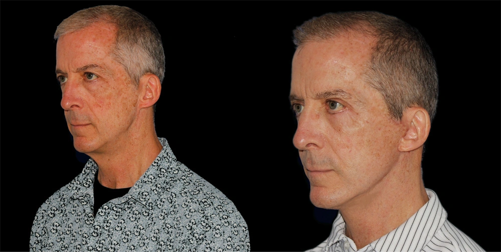 Before and After Photos Chevy Chase, MD Ikon Plastic Surgery and Medical Aesthetics Dr. James Economides