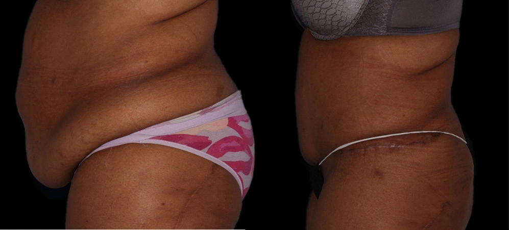 Before and After Photos Chevy Chase, MD Ikon Plastic Surgery and Medical Aesthetics Dr. James Economides