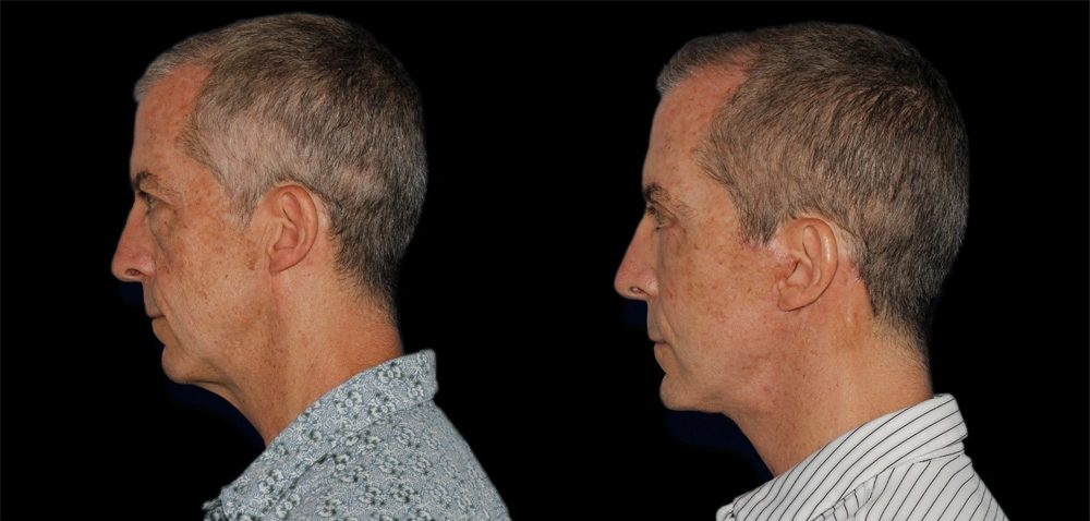 Before and After Photos Chevy Chase, MD Ikon Plastic Surgery and Medical Aesthetics Dr. James Economides