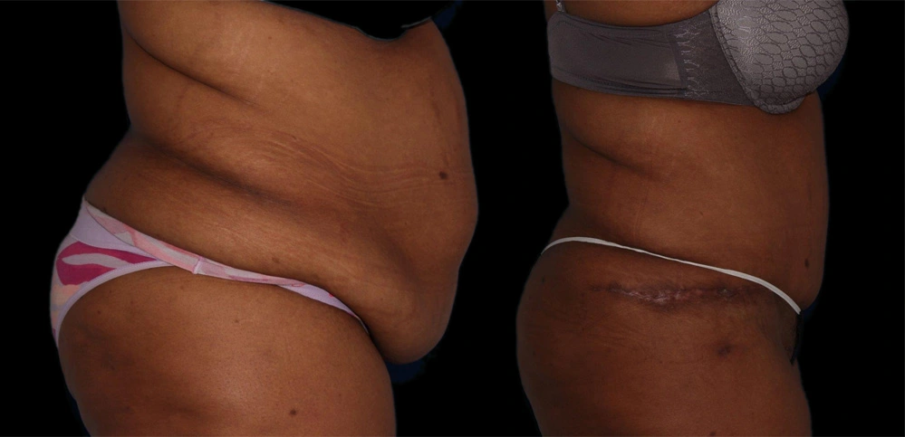 Before and After Photos Chevy Chase, MD Ikon Plastic Surgery and Medical Aesthetics Dr. James Economides