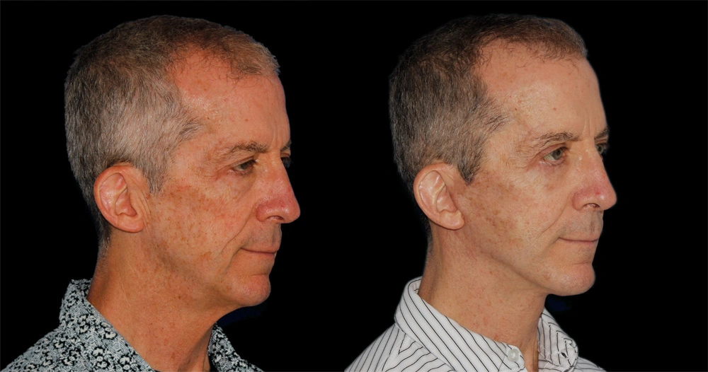Before and After Photos Chevy Chase, MD Ikon Plastic Surgery and Medical Aesthetics Dr. James Economides