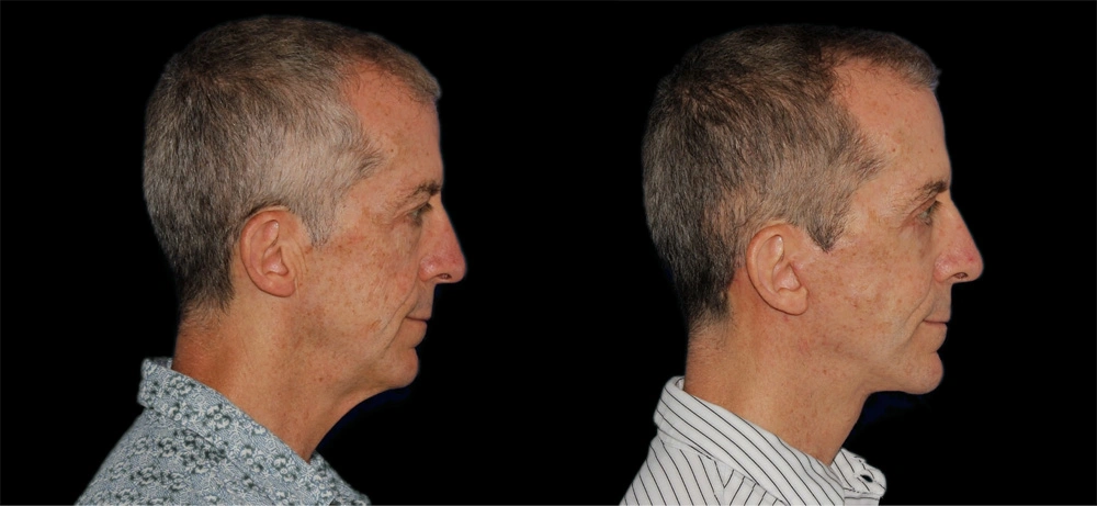 Before and After Photos Chevy Chase, MD Ikon Plastic Surgery and Medical Aesthetics Dr. James Economides