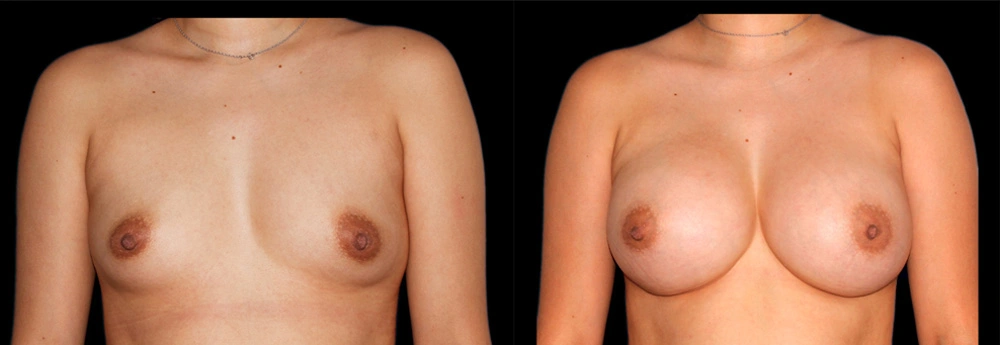 Before and After Photos Chevy Chase, MD Ikon Plastic Surgery and Medical Aesthetics Dr. James Economides