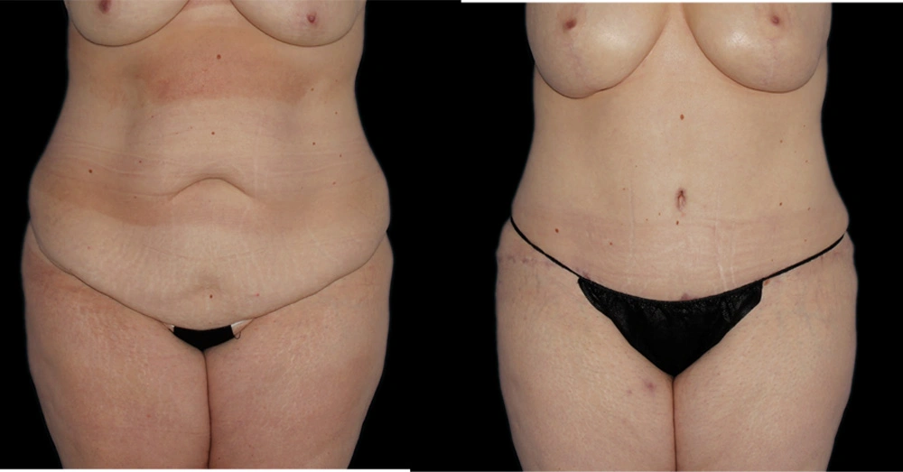 Before and After Photos Chevy Chase, MD Ikon Plastic Surgery and Medical Aesthetics Dr. James Economides