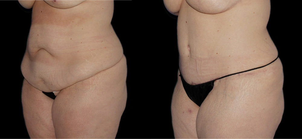 Before and After Photos Chevy Chase, MD Ikon Plastic Surgery and Medical Aesthetics Dr. James Economides