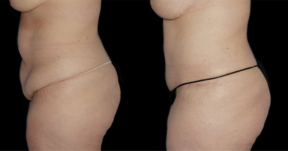 Before and After Photos Chevy Chase, MD Ikon Plastic Surgery and Medical Aesthetics Dr. James Economides