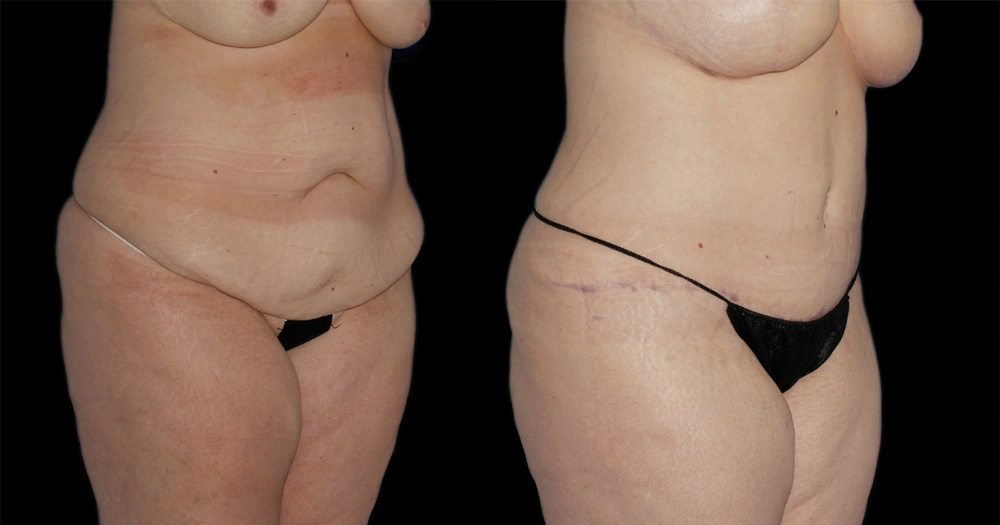 Before and After Photos Chevy Chase, MD Ikon Plastic Surgery and Medical Aesthetics Dr. James Economides