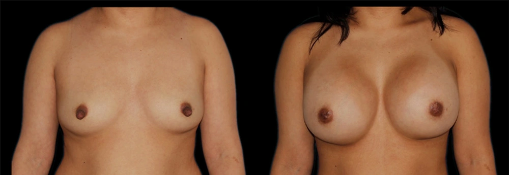 Before and After Photos Chevy Chase, MD Ikon Plastic Surgery and Medical Aesthetics Dr. James Economides
