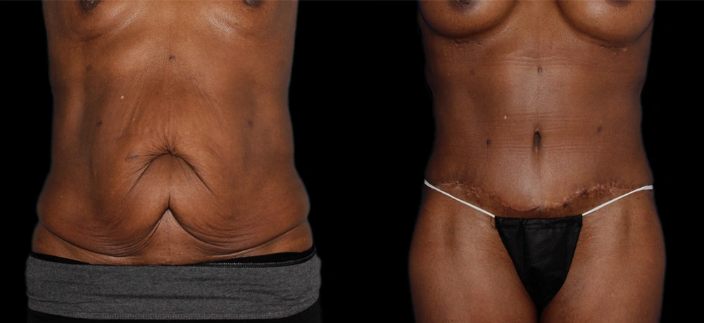 Before and After Photos Chevy Chase, MD Ikon Plastic Surgery and Medical Aesthetics Dr. James Economides