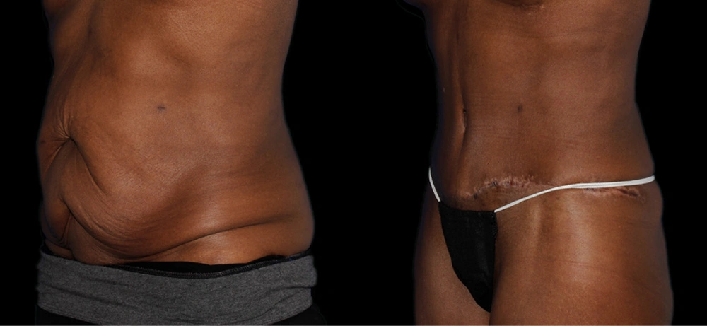 Before and After Photos Chevy Chase, MD Ikon Plastic Surgery and Medical Aesthetics Dr. James Economides