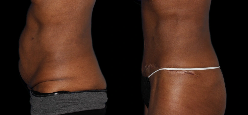 Before and After Photos Chevy Chase, MD Ikon Plastic Surgery and Medical Aesthetics Dr. James Economides