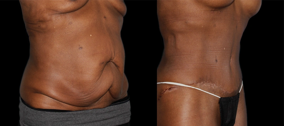 Before and After Photos Chevy Chase, MD Ikon Plastic Surgery and Medical Aesthetics Dr. James Economides