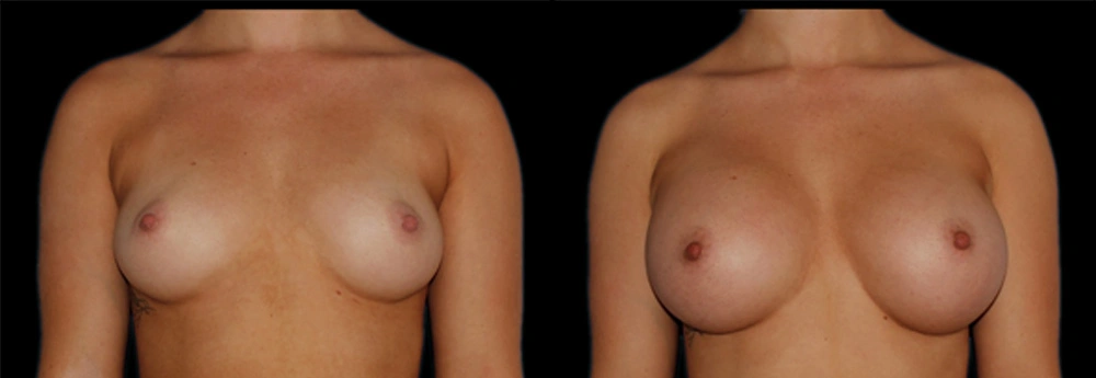 Before and After Photos Chevy Chase, MD Ikon Plastic Surgery and Medical Aesthetics Dr. James Economides