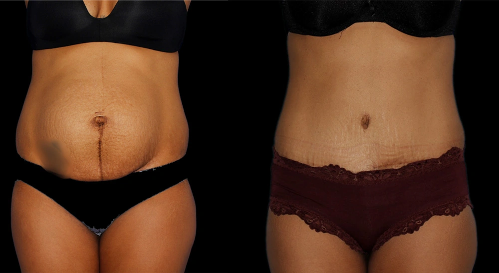 Before and After Photos Chevy Chase, MD Ikon Plastic Surgery and Medical Aesthetics Dr. James Economides