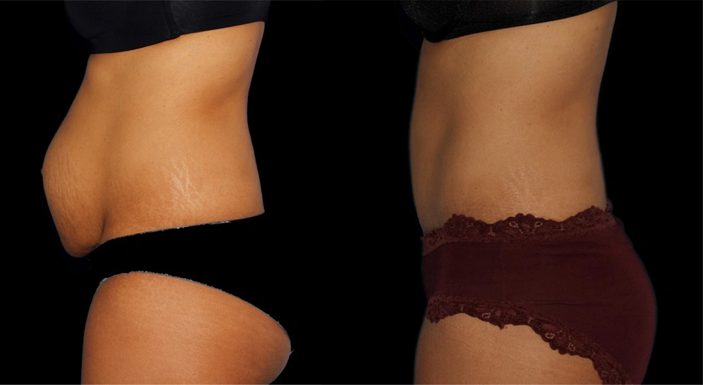 Before and After Photos Chevy Chase, MD Ikon Plastic Surgery and Medical Aesthetics Dr. James Economides