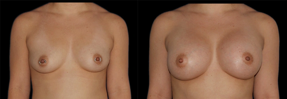 Before and After Photos Chevy Chase, MD Ikon Plastic Surgery and Medical Aesthetics Dr. James Economides