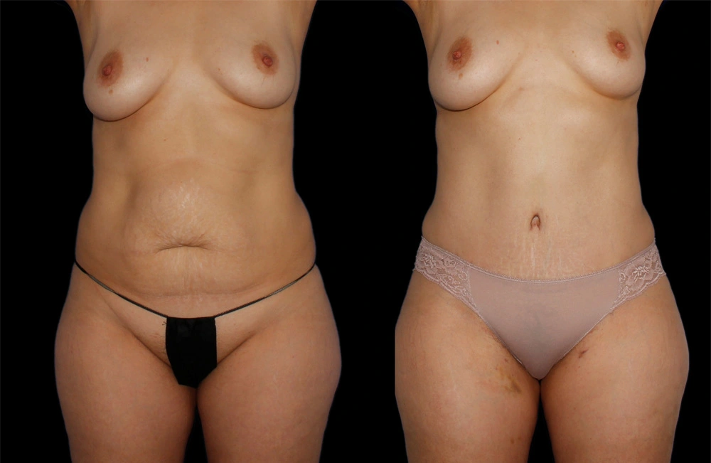 Before and After Photos Chevy Chase, MD Ikon Plastic Surgery and Medical Aesthetics Dr. James Economides
