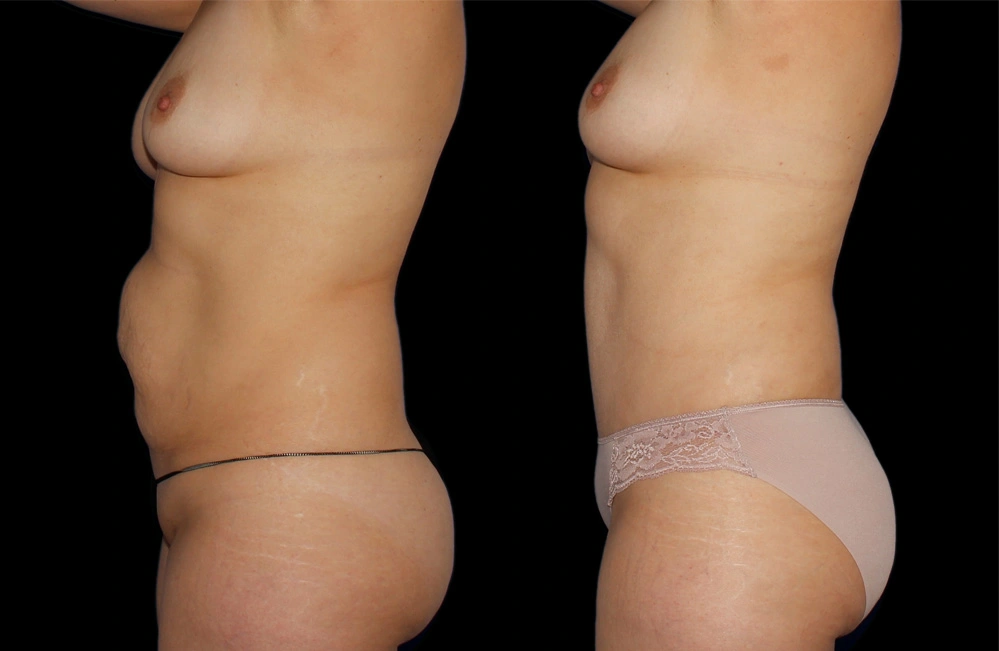Before and After Photos Chevy Chase, MD Ikon Plastic Surgery and Medical Aesthetics Dr. James Economides