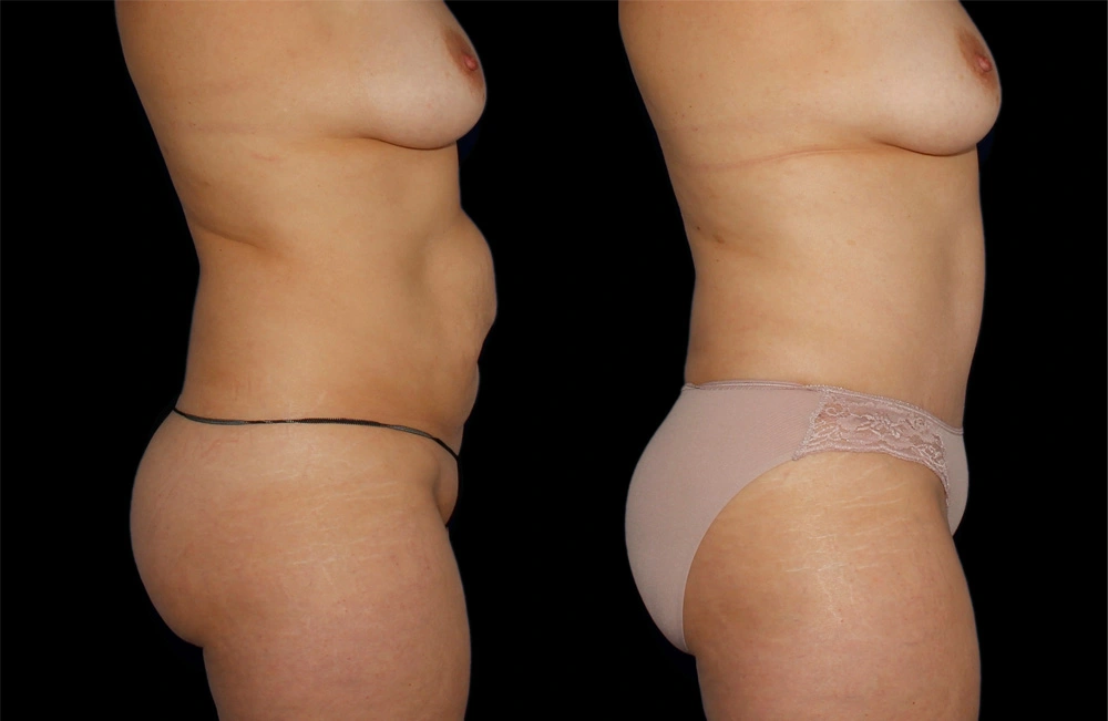 Before and After Photos Chevy Chase, MD Ikon Plastic Surgery and Medical Aesthetics Dr. James Economides