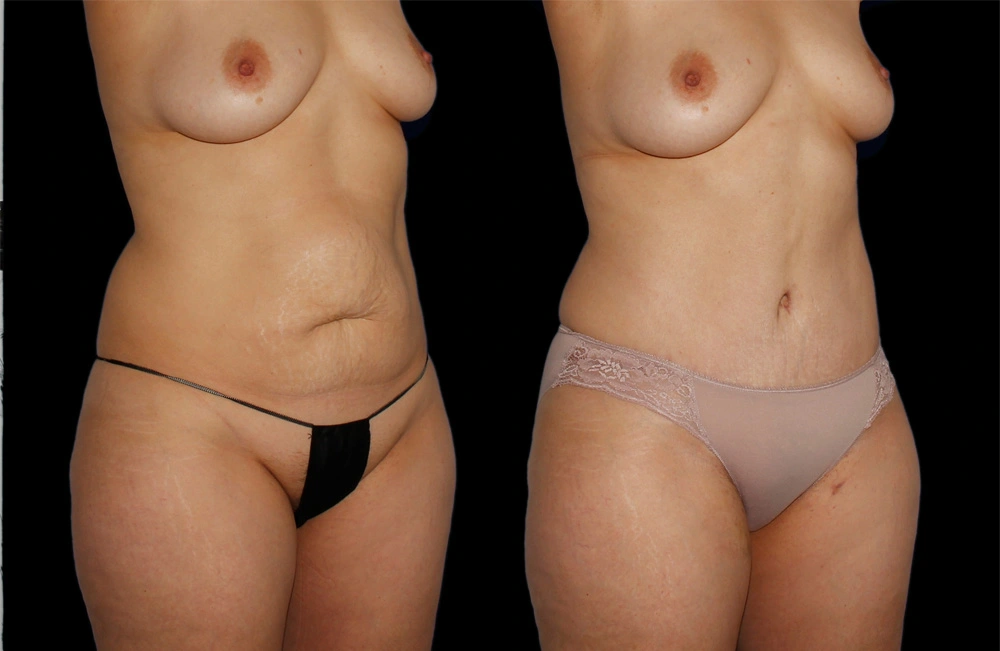 Before and After Photos Chevy Chase, MD Ikon Plastic Surgery and Medical Aesthetics Dr. James Economides