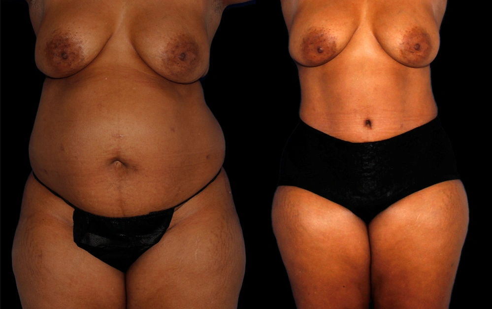 Before and After Photos Chevy Chase, MD Ikon Plastic Surgery and Medical Aesthetics Dr. James Economides