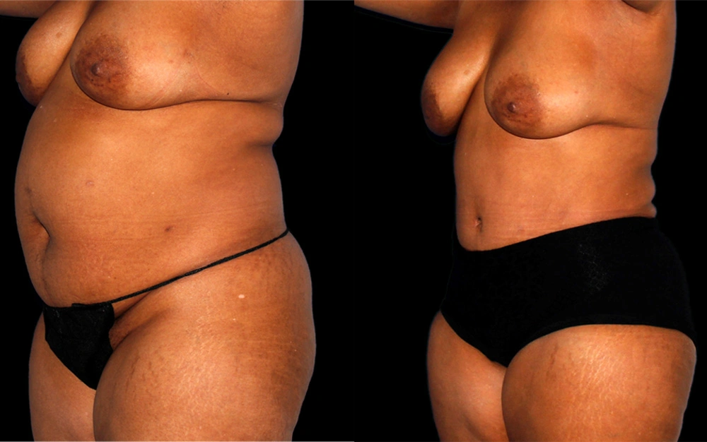 Before and After Photos Chevy Chase, MD Ikon Plastic Surgery and Medical Aesthetics Dr. James Economides