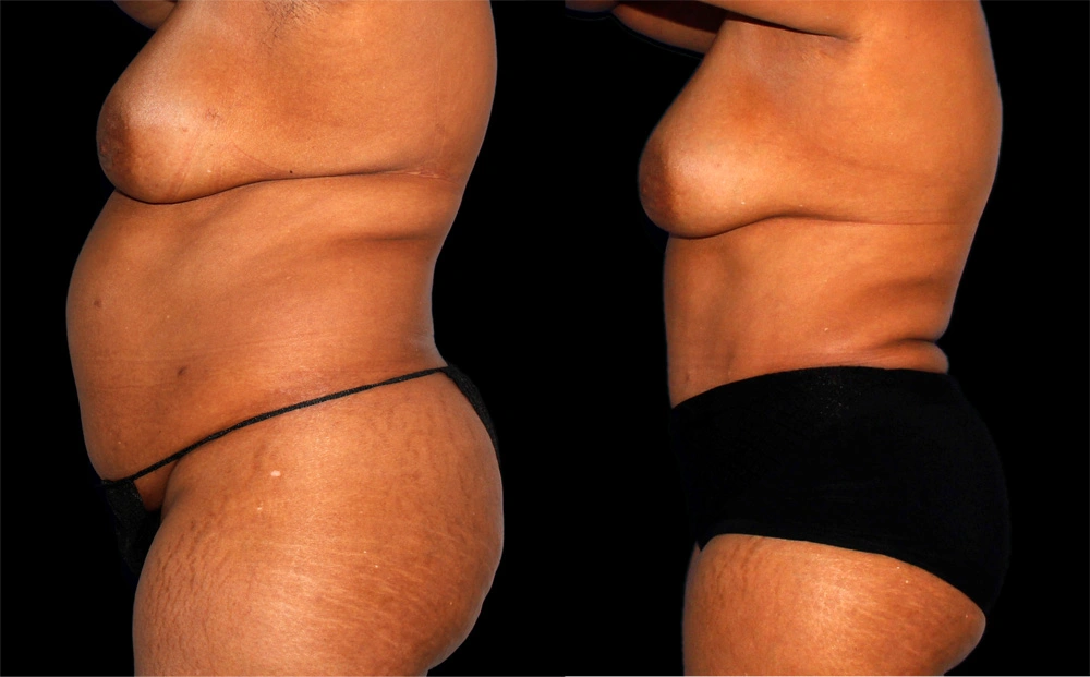 Before and After Photos Chevy Chase, MD Ikon Plastic Surgery and Medical Aesthetics Dr. James Economides