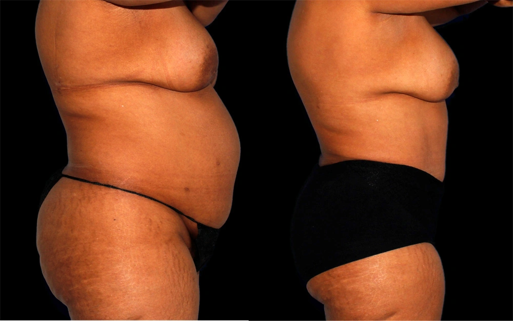 Before and After Photos Chevy Chase, MD Ikon Plastic Surgery and Medical Aesthetics Dr. James Economides